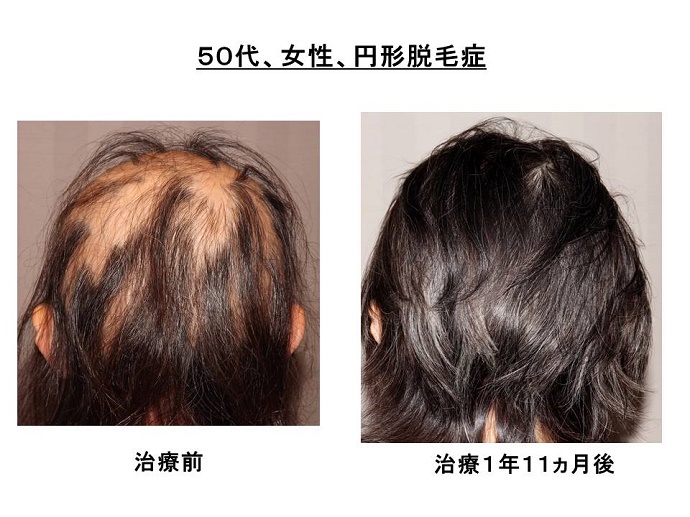 円形脱毛症　病院
